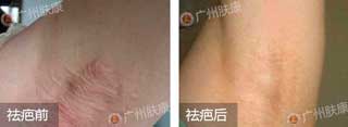 广州肤康皮肤病医院